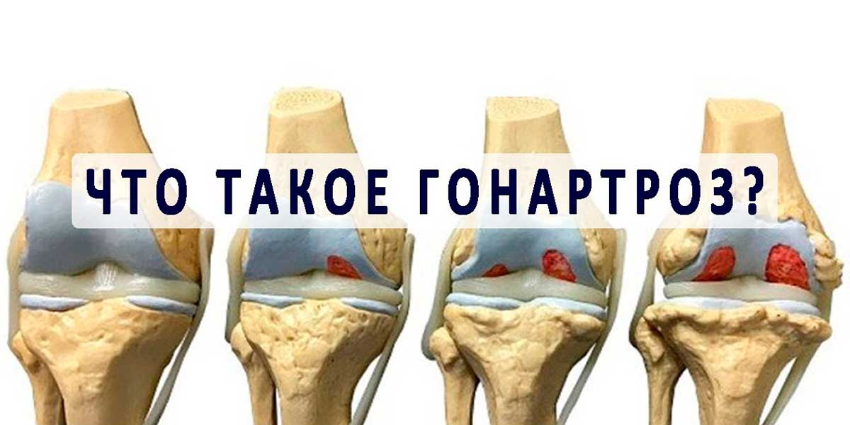 Клиники для лечения артроза коленных суставов